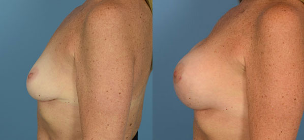 Photo of the patient’s body before & after the Breast Augmentation with Implantst surgery. Set 3: Patient 21