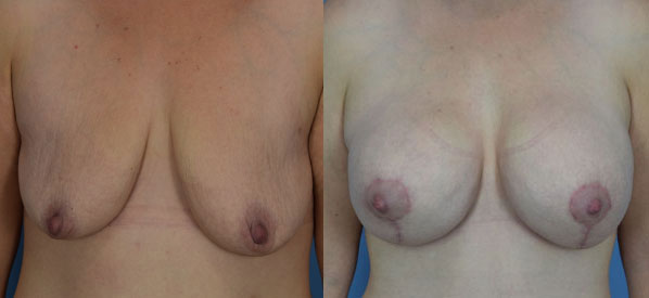 Photo of the patient’s body before & after the Breast Augmentation with Implantst surgery. Set 1: Patient 22