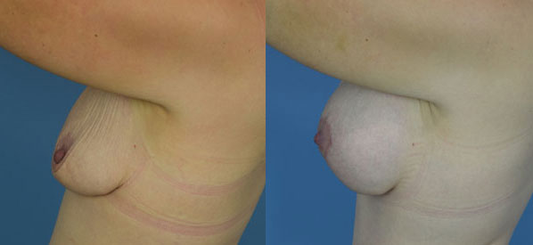 Photo of the patient’s body before & after the Breast Augmentation with Implantst surgery. Set 2: Patient 22