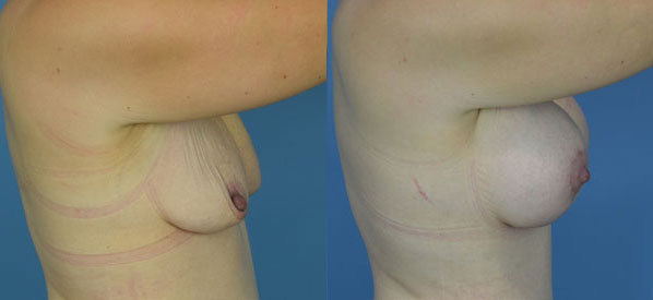 Photo of the patient’s body before & after the Breast Augmentation with Implantst surgery. Set 3: Patient 22