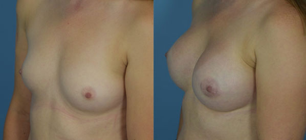 Photo of the patient’s body before & after the Breast Augmentation with Implantst surgery. Set 1: Patient 23