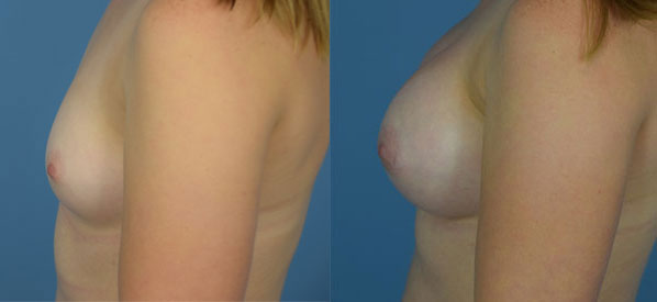 Photo of the patient’s body before & after the Breast Augmentation with Implantst surgery. Set 2: Patient 23