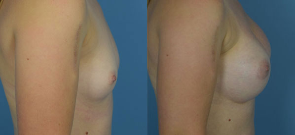 Photo of the patient’s body before & after the Breast Augmentation with Implantst surgery. Set 3: Patient 23