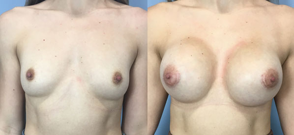 Photo of the patient’s body before & after the Breast Augmentation with Implantst surgery. Set 1: Patient 24