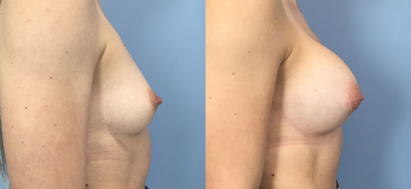 Photo of the patient’s body before & after the Breast Augmentation with Implantst surgery. Set 2: Patient 24