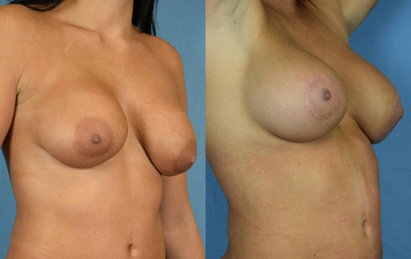 Photo of the patient’s body before & after the Breast Augmentation with Implantst surgery. Set 2: Patient 25