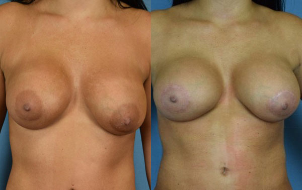 Photo of the patient’s body before & after the Breast Augmentation with Implantst surgery. Set 1: Patient 25