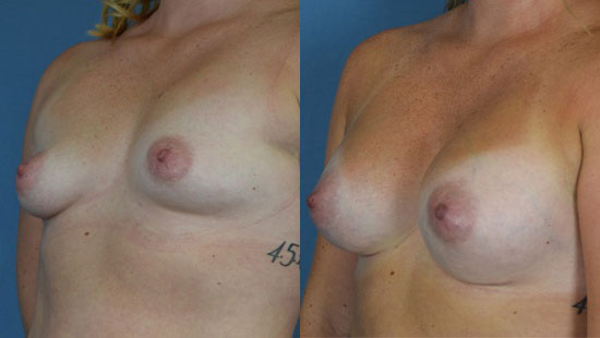 Photo of the patient’s body before & after the Breast Augmentation with Implantst surgery. Set 2: Patient 3