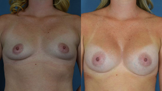 Photo of the patient’s body before & after the Breast Augmentation with Implantst surgery. Set 1: Patient 3