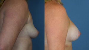 Breast Augmentation with Implants Before & After Patient Miniature Set