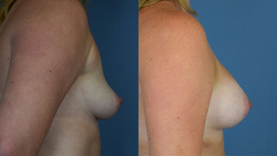 Photo of the patient’s body before & after the Breast Augmentation with Implantst surgery. Set 2: Patient 3