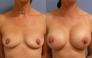 Breast Augmentation with Implants Before & After Patient Miniature Set