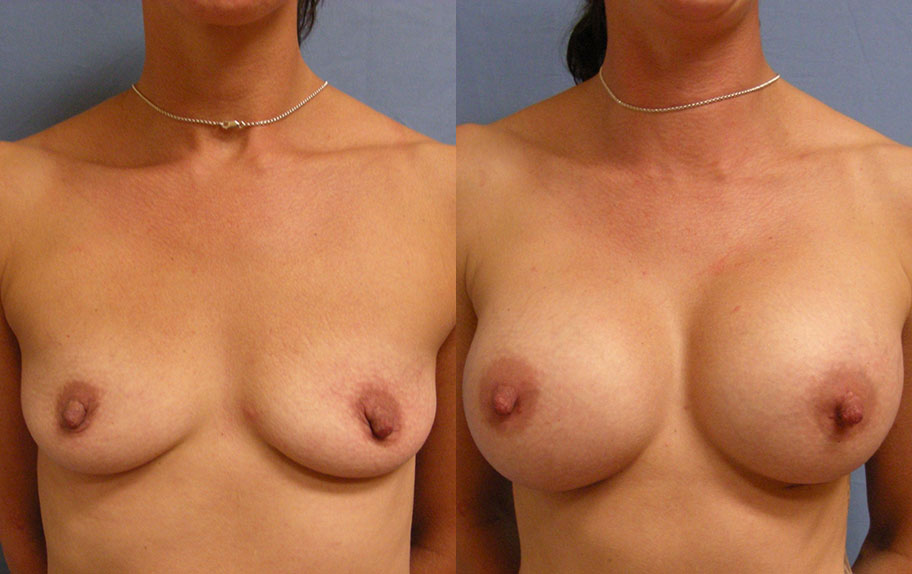 Photo of the patient’s body before & after the Breast Augmentation with Implantst surgery. Set 1: Patient 5