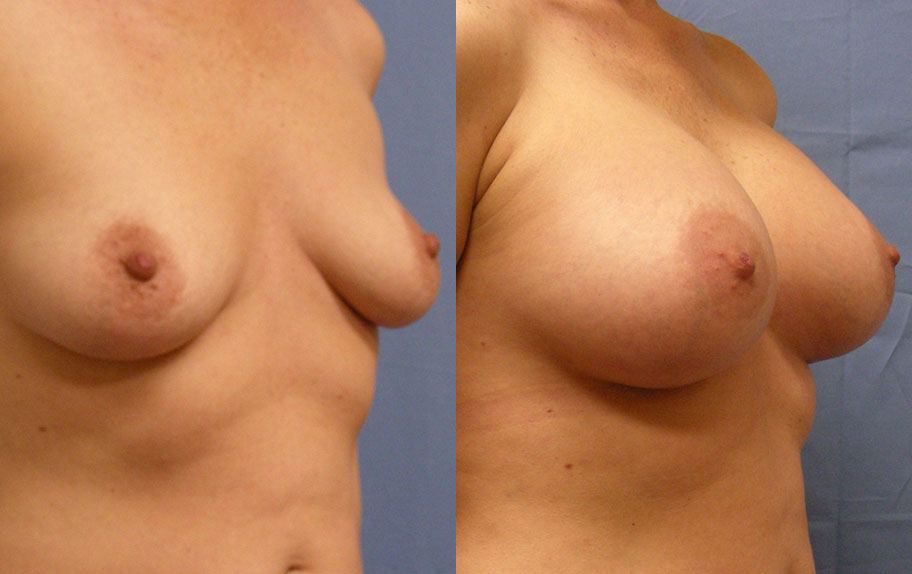 Photo of the patient’s body before & after the Breast Augmentation with Implantst surgery. Set 2: Patient 5