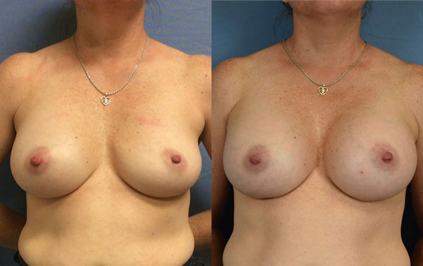 Photo of the patient’s body before & after the Breast Augmentation with Implantst surgery. Set 1: Patient 6