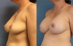 Breast Augmentation with Implants Before & After Patient Miniature Set