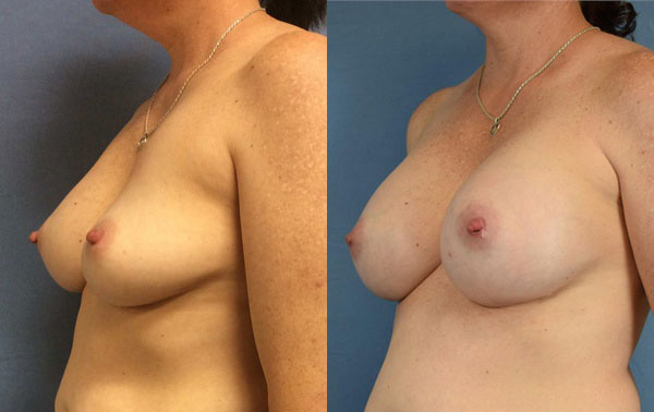 Photo of the patient’s body before & after the Breast Augmentation with Implantst surgery. Set 2: Patient 6
