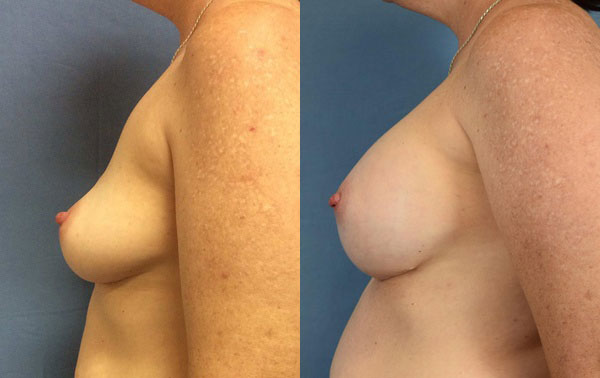 Photo of the patient’s body before & after the Breast Augmentation with Implantst surgery. Set 3: Patient 6