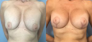 Breast Augmentation with Implants Before & After Patient Miniature Set