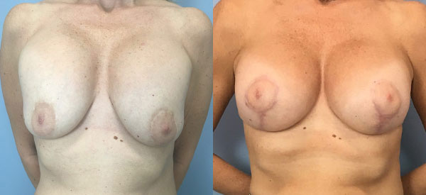 Photo of the patient’s body before & after the Breast Augmentation with Implantst surgery. Set 1: Patient 7