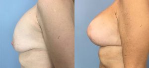 Breast Augmentation with Implants Before & After Patient Miniature Set
