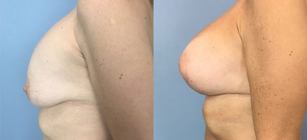 Photo of the patient’s body before & after the Breast Augmentation with Implantst surgery. Set 2: Patient 7