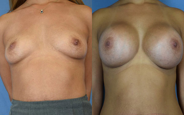 Photo of the patient’s body before & after the Breast Augmentation with Implantst surgery. Set 1: Patient 8