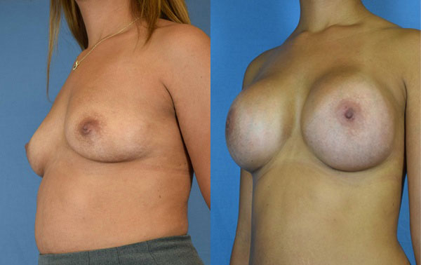 Photo of the patient’s body before & after the Breast Augmentation with Implantst surgery. Set 2: Patient 8