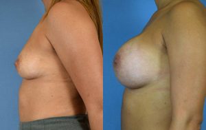 Breast Augmentation with Implants Before & After Patient Miniature Set
