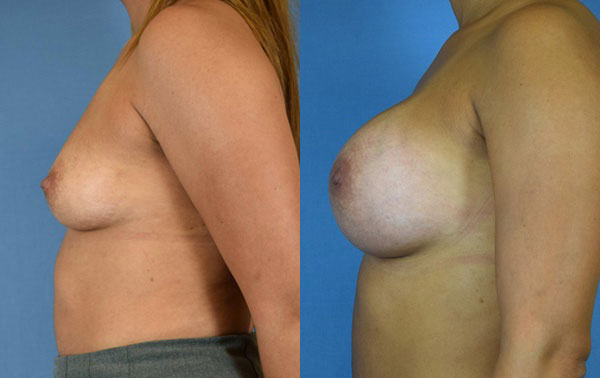 Photo of the patient’s body before & after the Breast Augmentation with Implantst surgery. Set 3: Patient 8