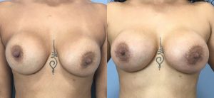 Breast Augmentation with Implants Before & After Patient Miniature Set