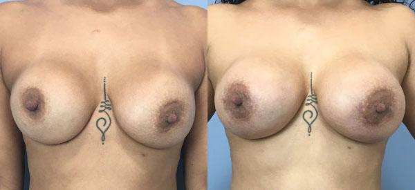 Photo of the patient’s body before & after the Breast Augmentation with Implantst surgery. Set 1: Patient 9