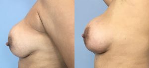 Breast Augmentation with Implants Before & After Patient Miniature Set