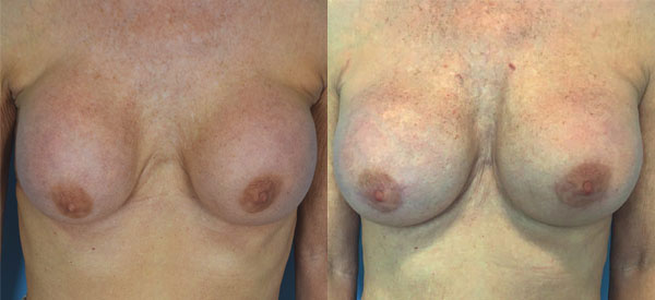 Photo of the patient’s body before & after the Breast Augmentation with Implantst surgery. Set 1: Patient 10