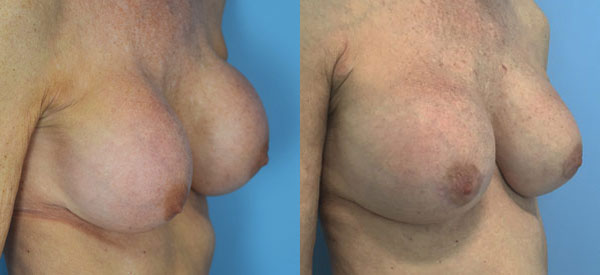 Photo of the patient’s body before & after the Breast Augmentation with Implantst surgery. Set 2: Patient 10