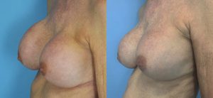 Breast Augmentation with Implants Before & After Patient Miniature Set
