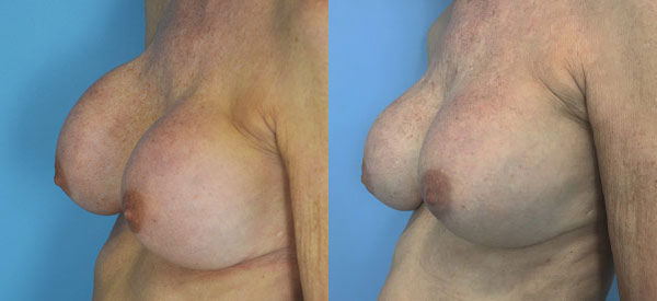 Photo of the patient’s body before & after the Breast Augmentation with Implantst surgery. Set 3: Patient 10