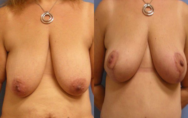 Photo of the patient’s body before & after the Breast Lift surgery. Set 1: Patient 1
