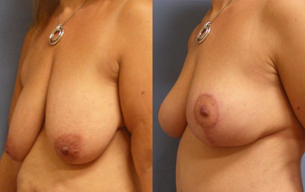 Photo of the patient’s body before & after the Breast Lift surgery. Set 2: Patient 1