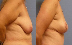 Breast Lift Before & After Patient Miniature Set