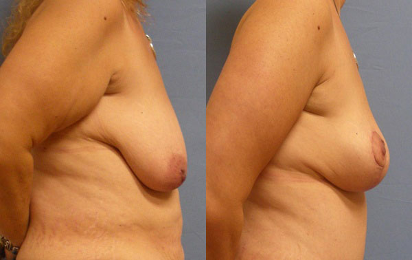 Photo of the patient’s body before & after the Breast Lift surgery. Set 3: Patient 1