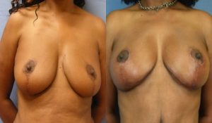 Breast Lift Before & After Patient2