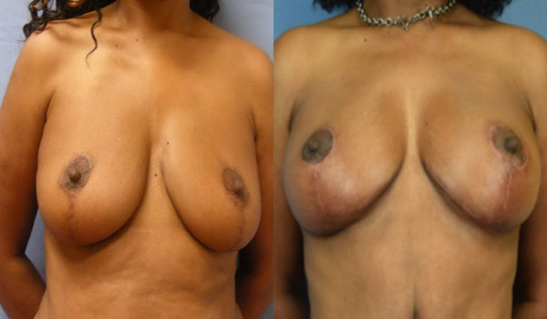Photo of the patient’s body before & after the Breast Lift surgery. Set 1: Patient 2
