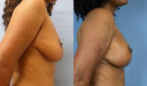 Breast Lift Before & After Patient Miniature Set