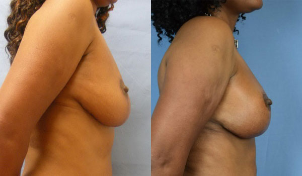 Photo of the patient’s body before & after the Breast Lift surgery. Set 2: Patient 2