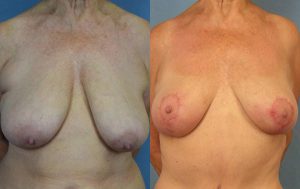 Breast Lift Before & After Patient Miniature Set
