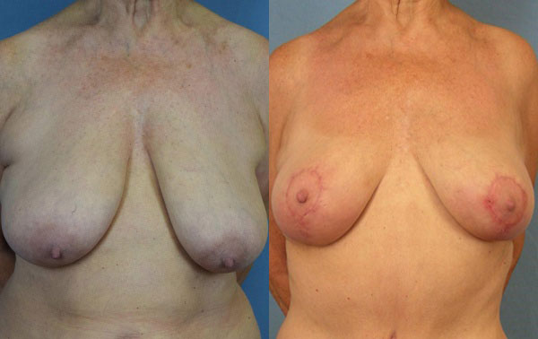 Photo of the patient’s body before & after the Breast Lift surgery. Set 1: Patient 3