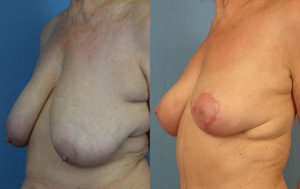 Photo of the patient’s body before & after the Breast Lift surgery. Set 2: Patient 3