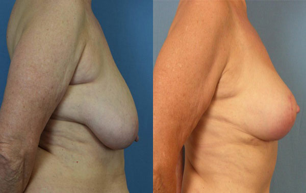 Photo of the patient’s body before & after the Breast Lift surgery. Set 3: Patient 3