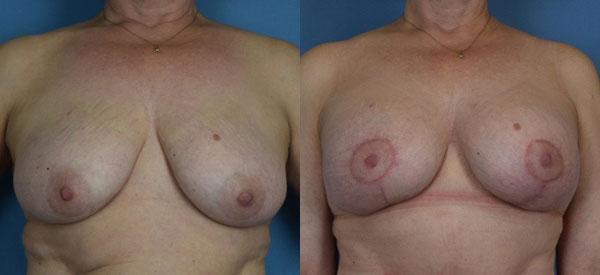 Photo of the patient’s body before & after the Breast Lift surgery. Set 1: Patient 4